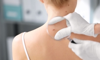 O nouă campanie preventivă Euromelanoma, derulată de Societatea Română de Dermatologie