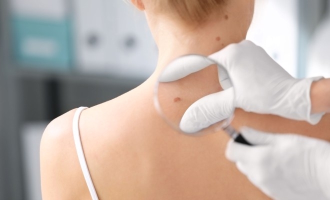 O nouă campanie preventivă Euromelanoma, derulată de Societatea Română de Dermatologie